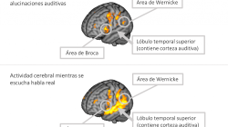 Es troben les àrees cerebrals implicades en les al·lucinacions  auditives dels pacients amb esquizofrènia